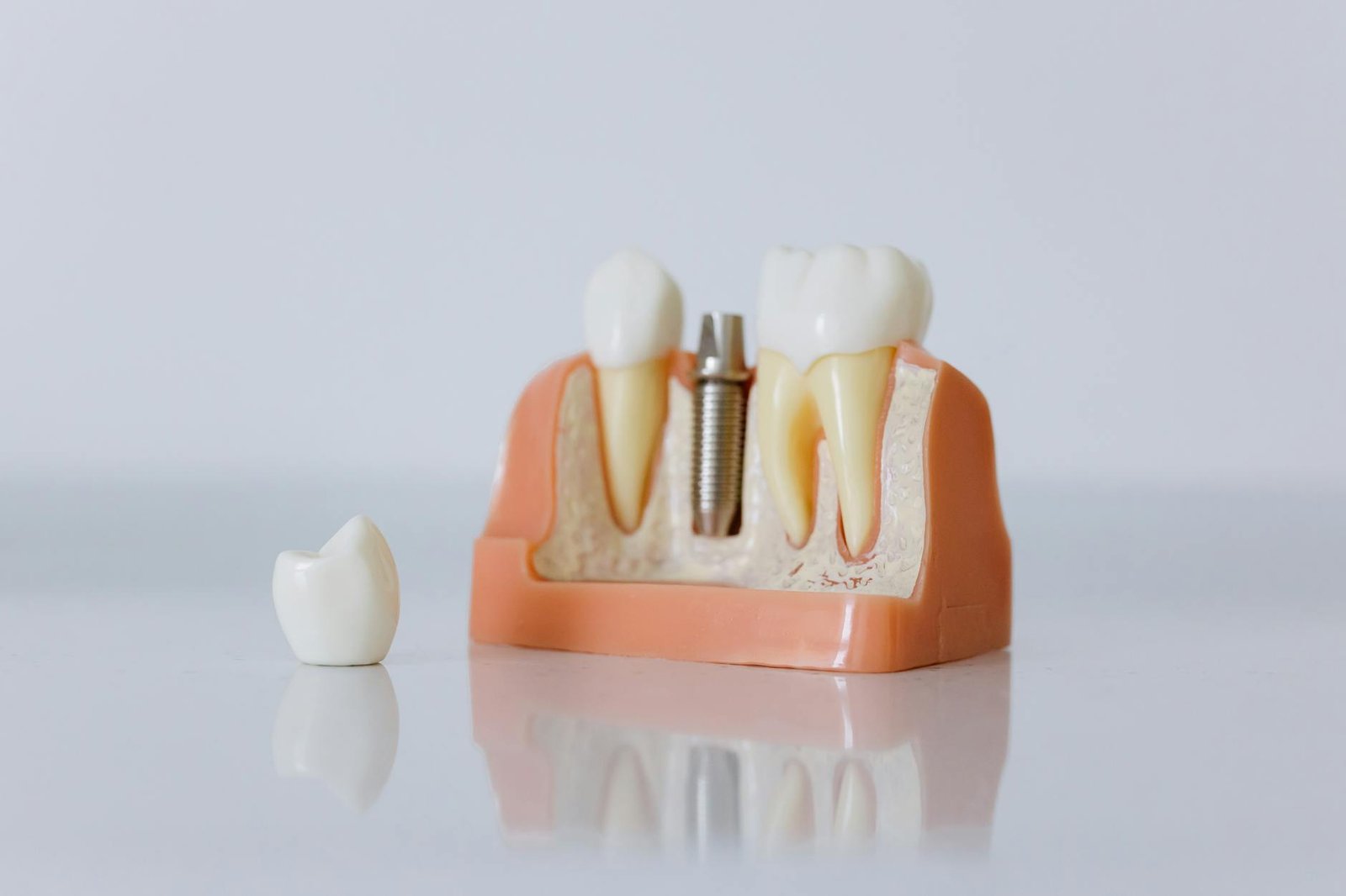 Sandhya Dental root canal specialist in Nara Road illustration for Sandhya Dental Root Canal Specialist: Best Modern Dentistr